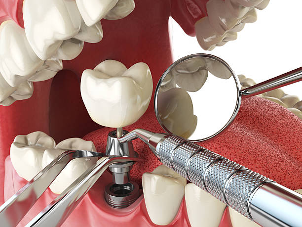 Best Emergency Tooth Extraction in , SC