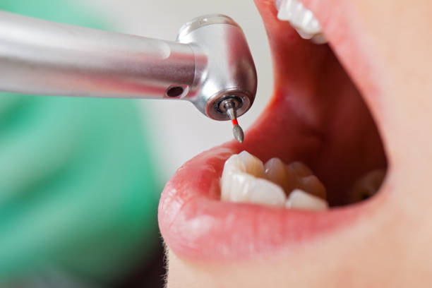 Best Emergency Wisdom Teeth Removal in , SC